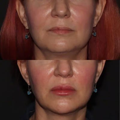 Fillers Before & After Gallery - Patient 162911 - Image 1