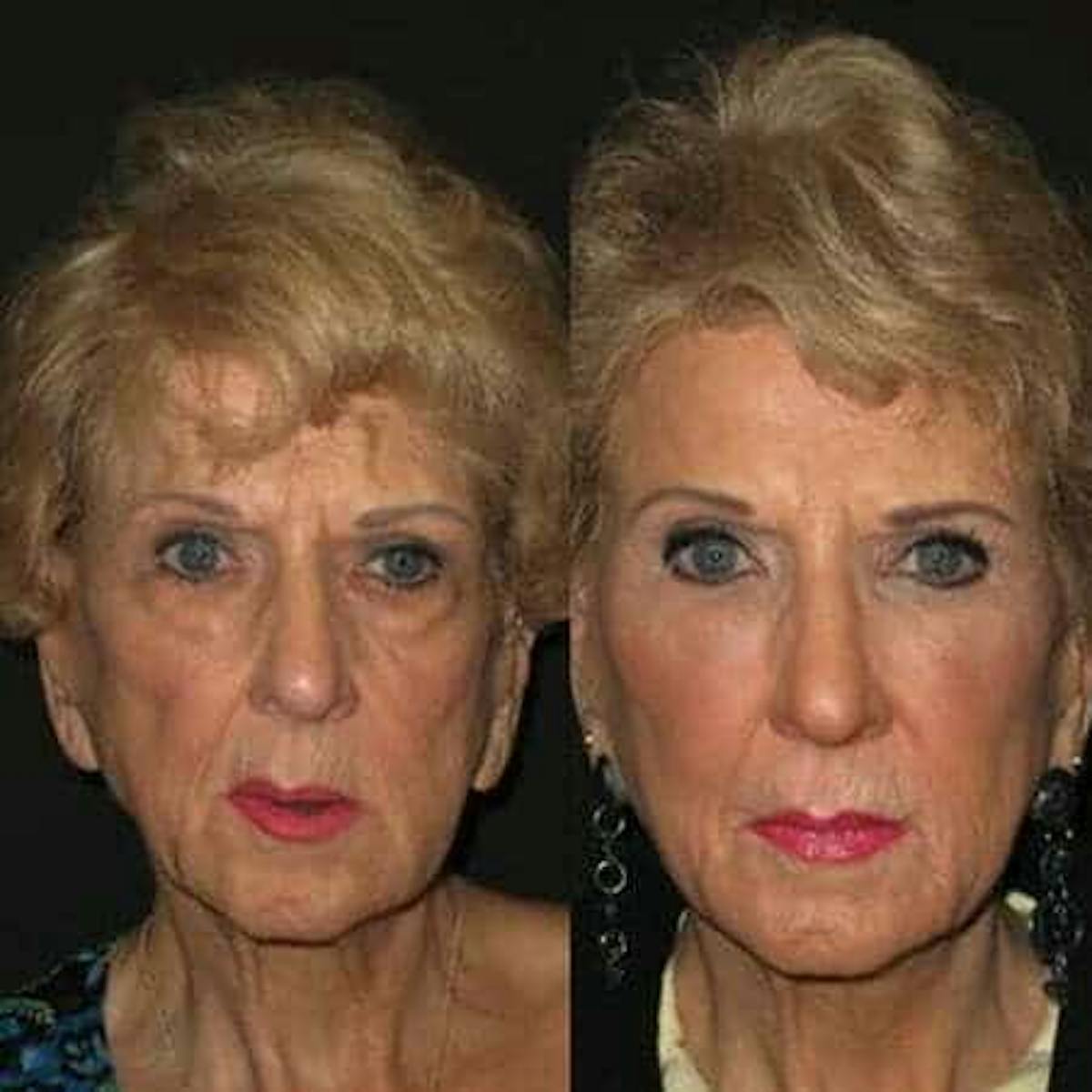 Fillers Before & After Gallery - Patient 325495 - Image 1