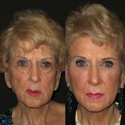 Fillers Before & After Gallery - Patient 325495 - Image 1