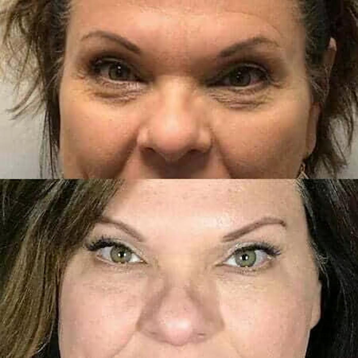 Fillers Before & After Gallery - Patient 373927 - Image 1