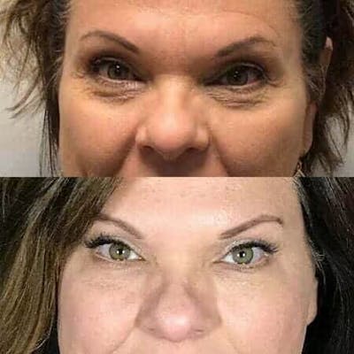 Fillers Before & After Gallery - Patient 373927 - Image 1