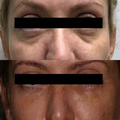 Fillers Before & After Gallery - Patient 262799 - Image 1