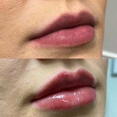 Fillers Before & After Gallery - Patient 272835 - Image 1
