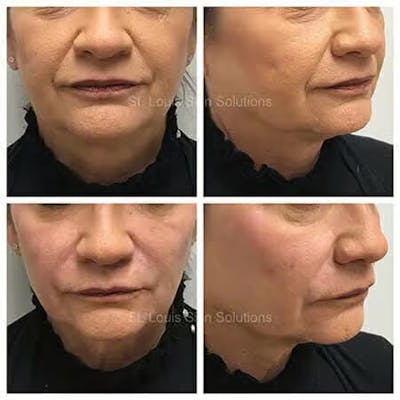 Fillers Before & After Gallery - Patient 203652 - Image 1