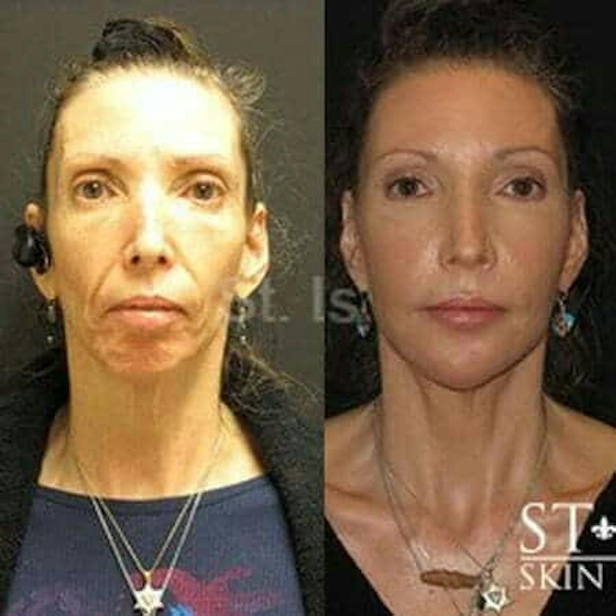 Fillers Before & After Gallery - Patient 312023 - Image 1