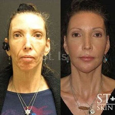 Fillers Before & After Gallery - Patient 312023 - Image 1