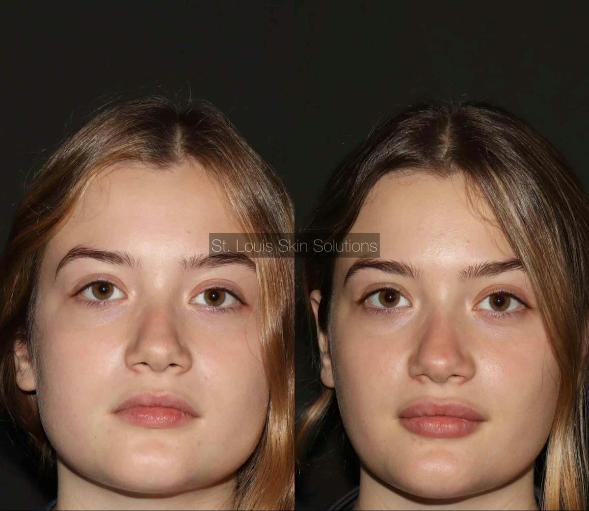 Fillers Before & After Gallery - Patient 410988 - Image 1