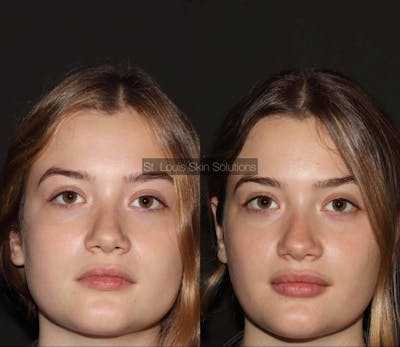 Fillers Before & After Gallery - Patient 410988 - Image 1