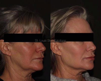 Fillers Before & After Gallery - Patient 412541 - Image 1