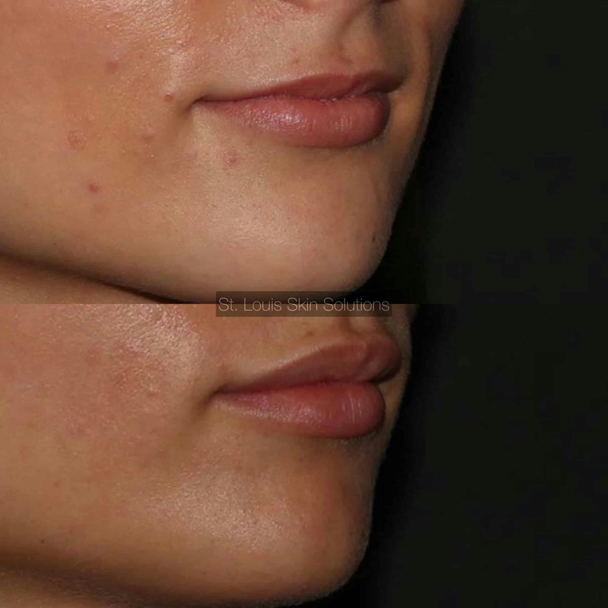 Fillers Before & After Gallery - Patient 225605 - Image 1