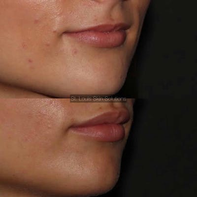 Fillers Before & After Gallery - Patient 225605 - Image 1
