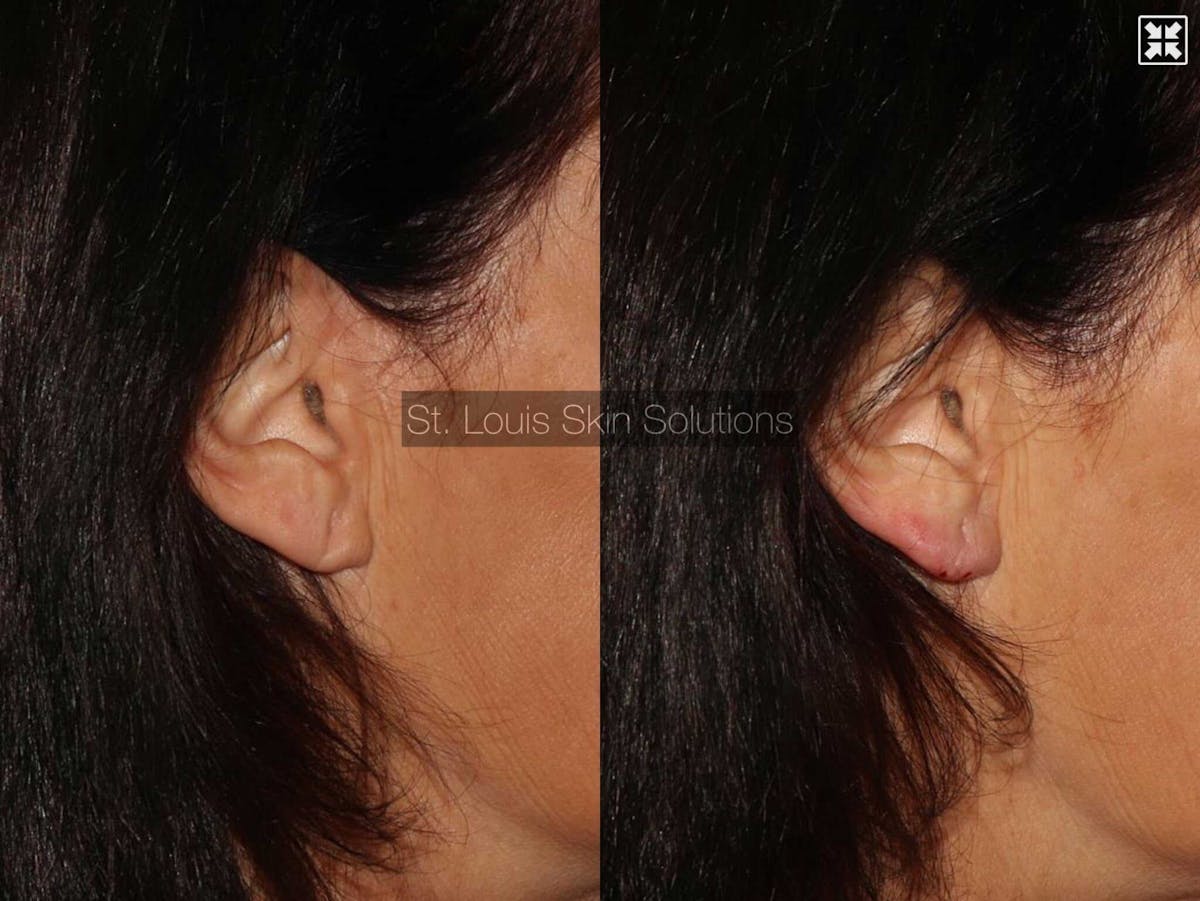 Fillers Before & After Gallery - Patient 244621 - Image 1