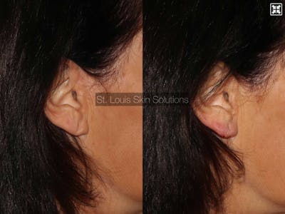 Fillers Before & After Gallery - Patient 244621 - Image 1
