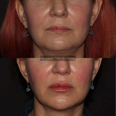 Fillers Before & After Gallery - Patient 270443 - Image 1