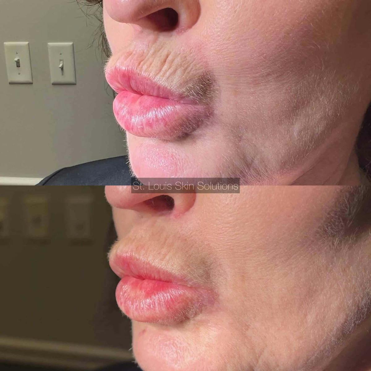 Fillers Before & After Gallery - Patient 421181 - Image 1