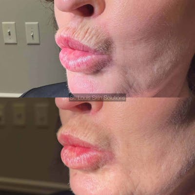 Fillers Before & After Gallery - Patient 421181 - Image 1