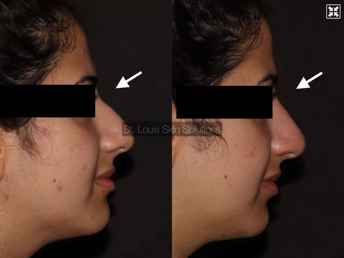 Fillers Before & After Gallery - Patient 298628 - Image 1