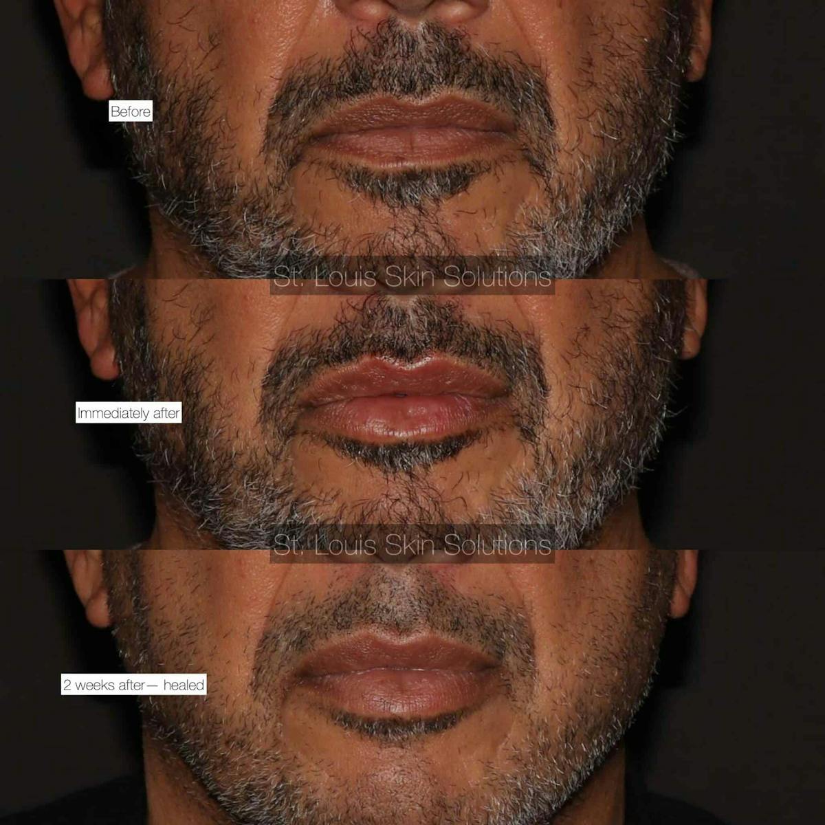 Fillers Before & After Gallery - Patient 264819 - Image 1