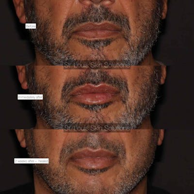 Fillers Before & After Gallery - Patient 264819 - Image 1