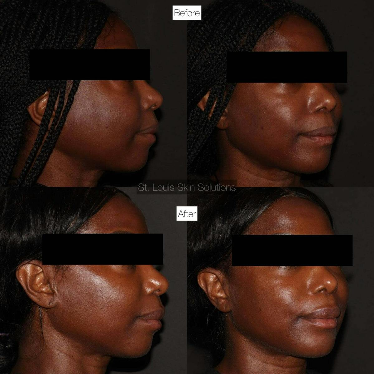 Fillers Before & After Gallery - Patient 275373 - Image 1