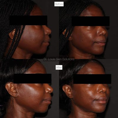 Fillers Before & After Gallery - Patient 275373 - Image 1
