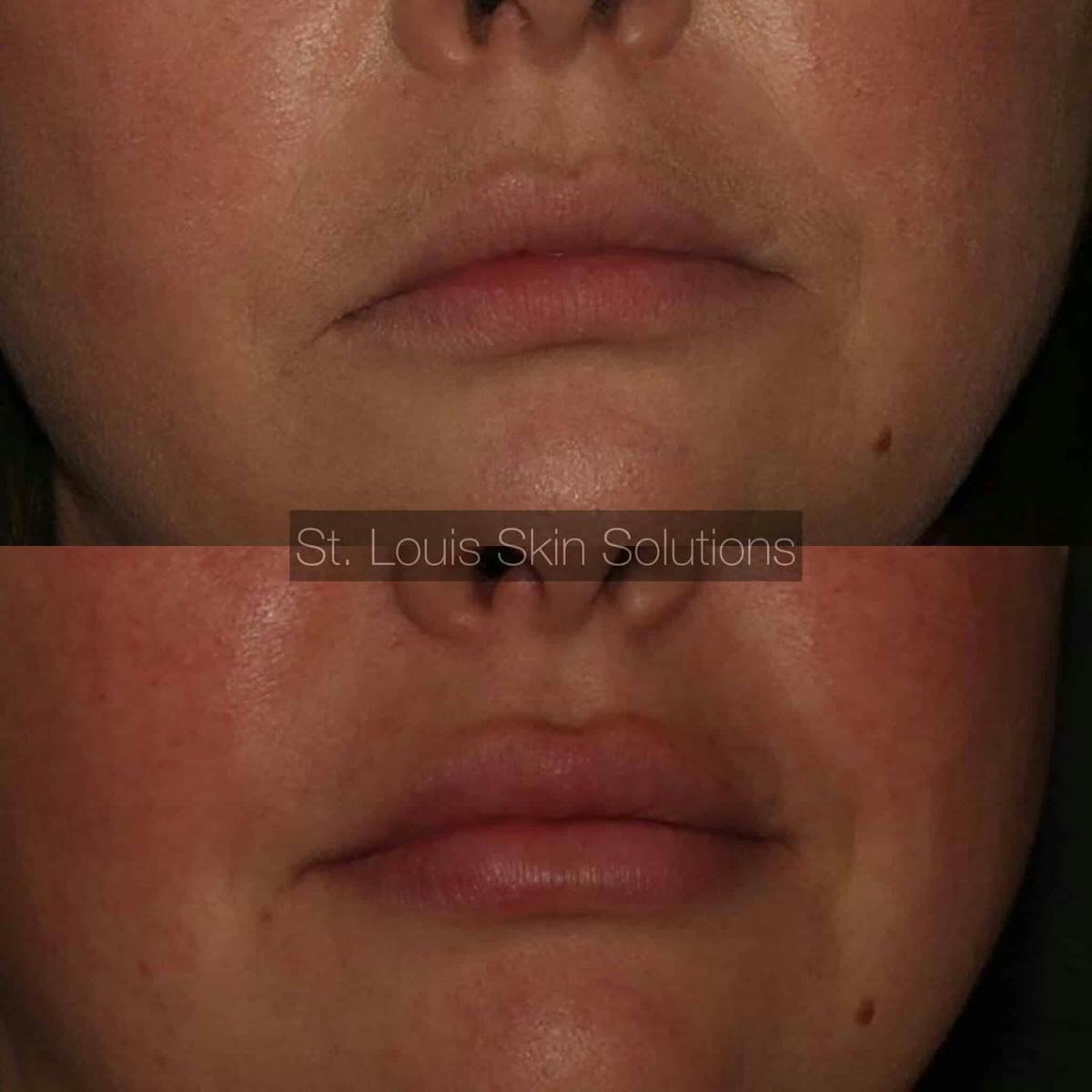 Fillers Before & After Gallery - Patient 562844 - Image 1