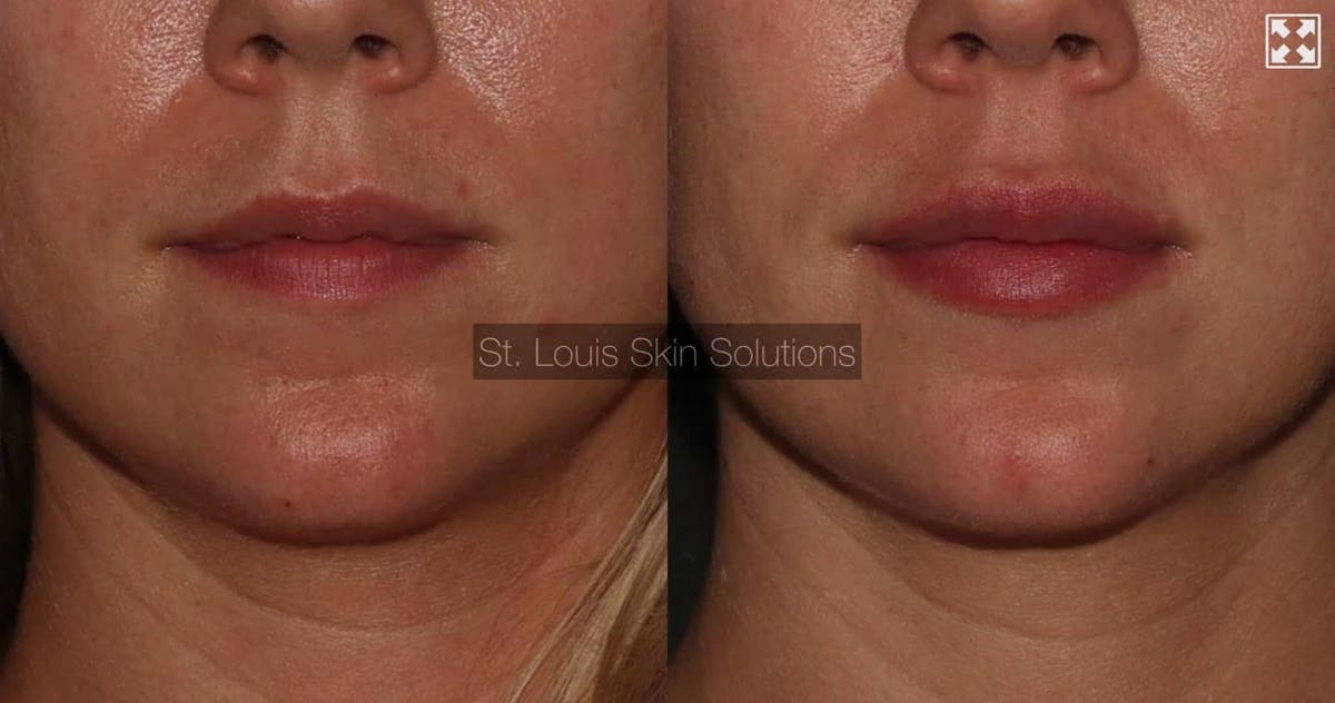 Fillers Before & After Gallery - Patient 451133 - Image 1