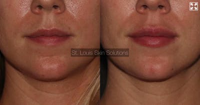 Fillers Before & After Gallery - Patient 451133 - Image 1