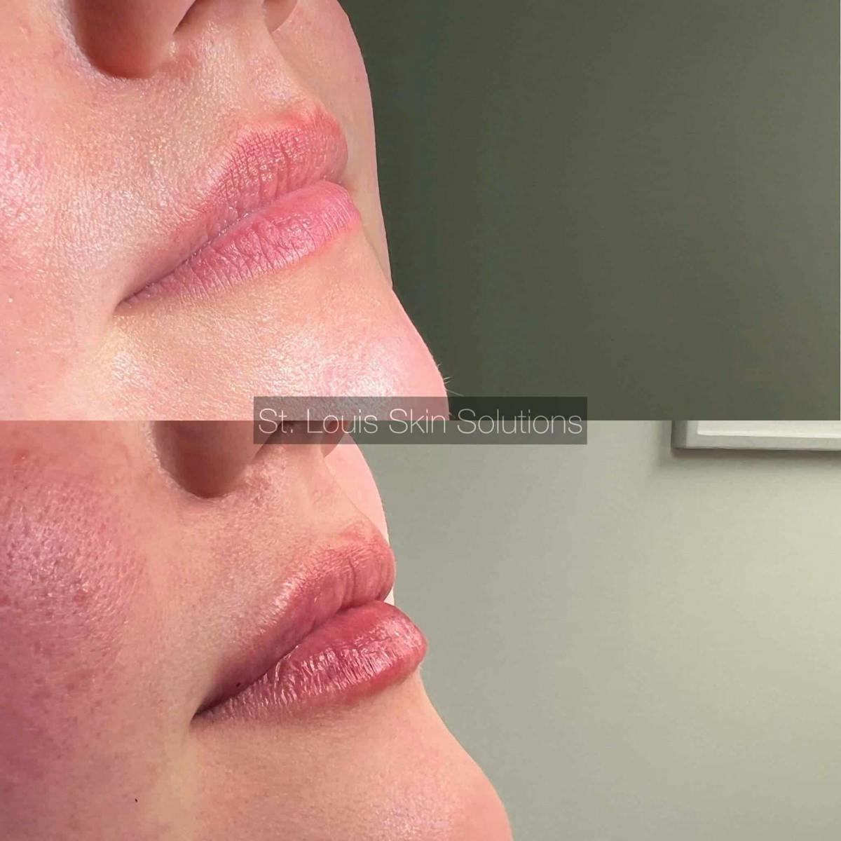Fillers Before & After Gallery - Patient 653625 - Image 1