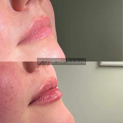Fillers Before & After Gallery - Patient 653625 - Image 1