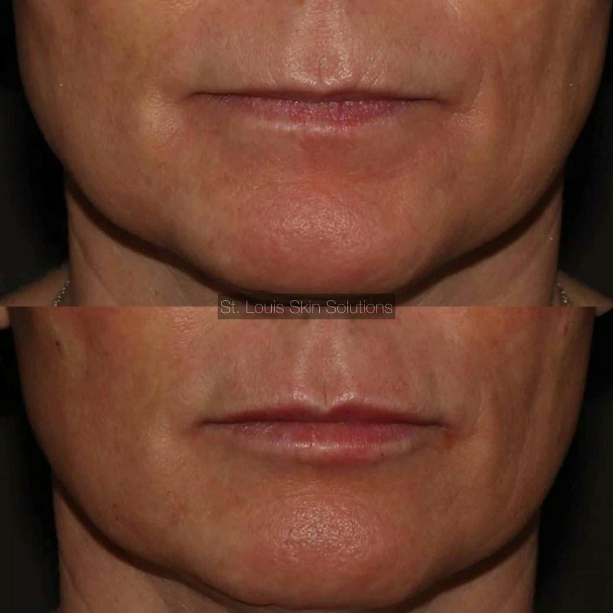 Fillers Before & After Gallery - Patient 592345 - Image 1