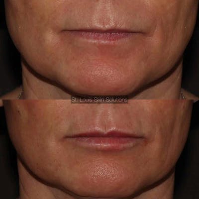 Fillers Before & After Gallery - Patient 592345 - Image 1