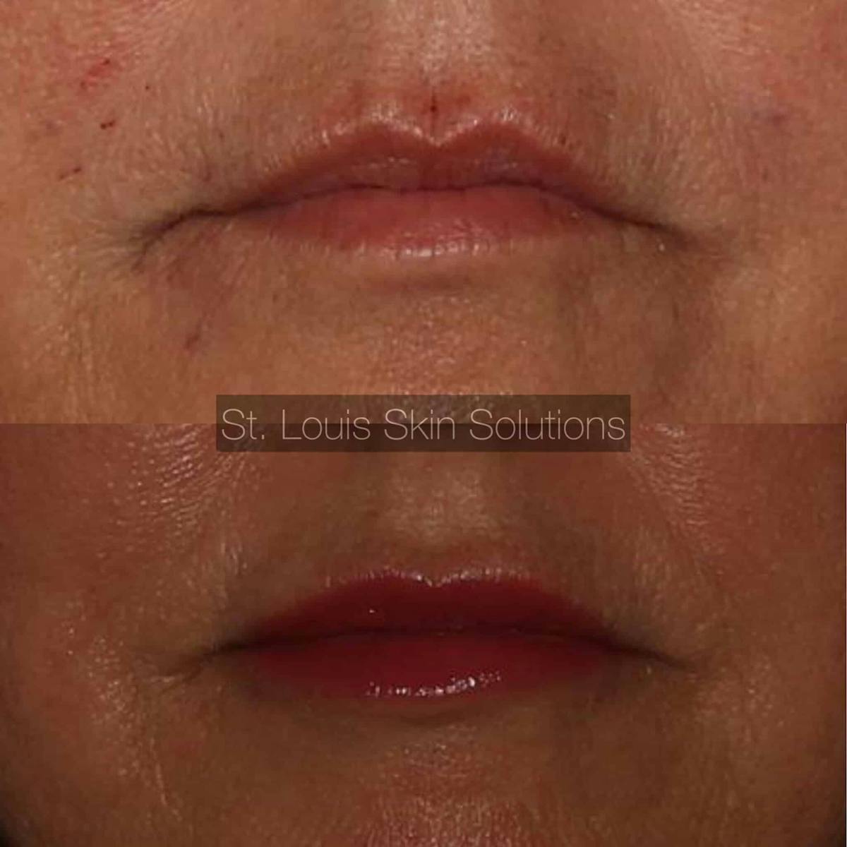 Fillers Before & After Gallery - Patient 314856 - Image 1