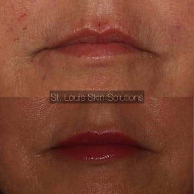 Fillers Before & After Gallery - Patient 314856 - Image 1