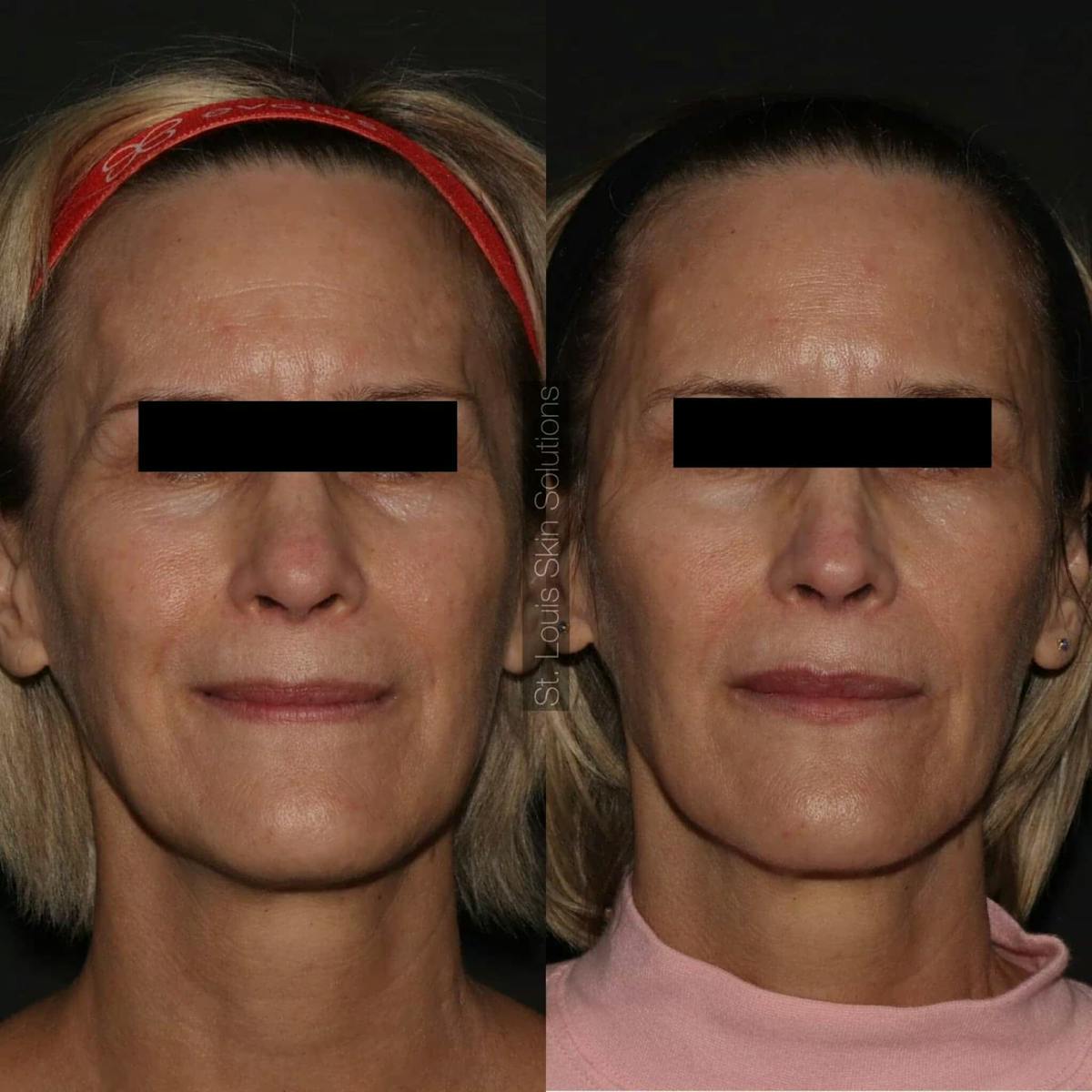 Fillers Before & After Gallery - Patient 350758 - Image 1