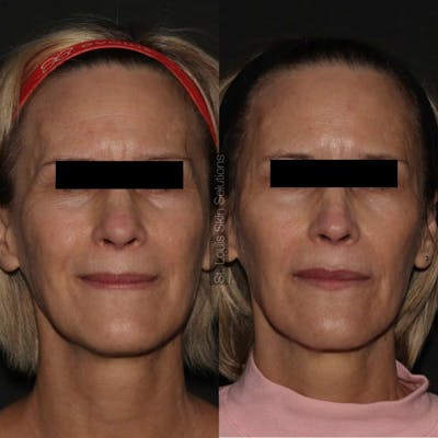 Fillers Before & After Gallery - Patient 350758 - Image 1