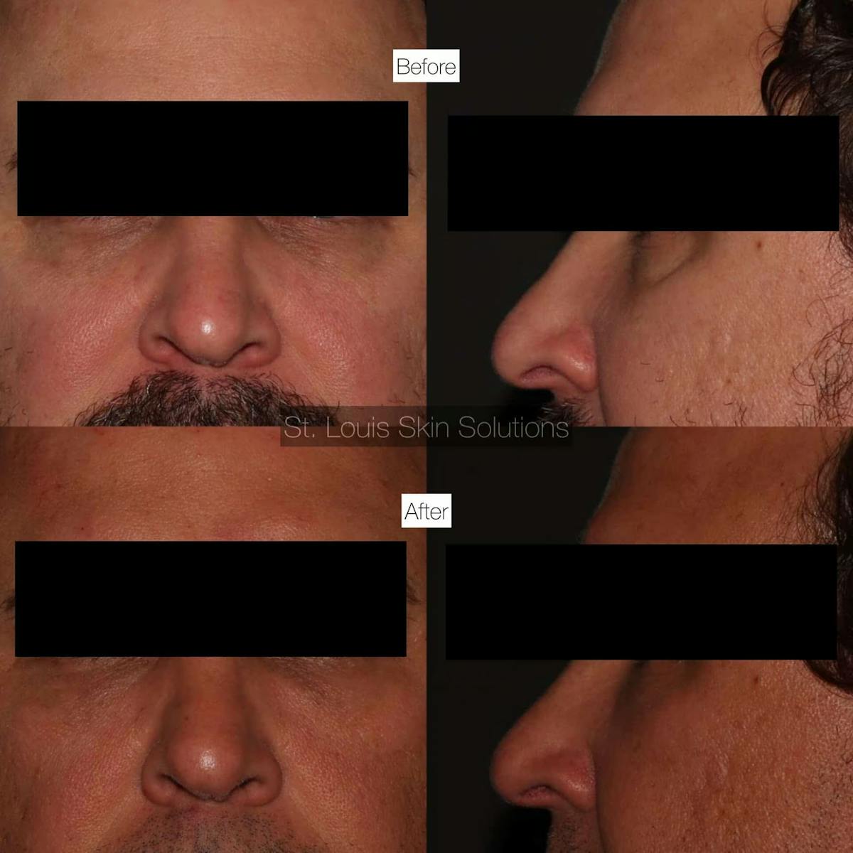 Fillers Before & After Gallery - Patient 192808 - Image 1