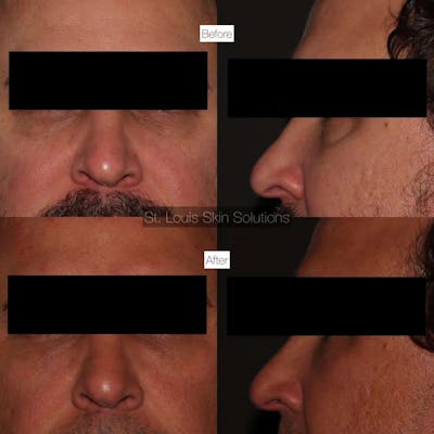 Fillers Before & After Gallery - Patient 192808 - Image 1