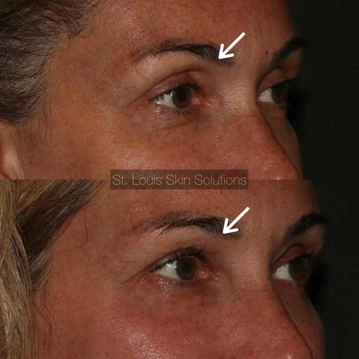 Fillers Before & After Gallery - Patient 113854 - Image 1