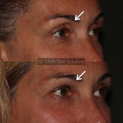 Fillers Before & After Gallery - Patient 113854 - Image 1