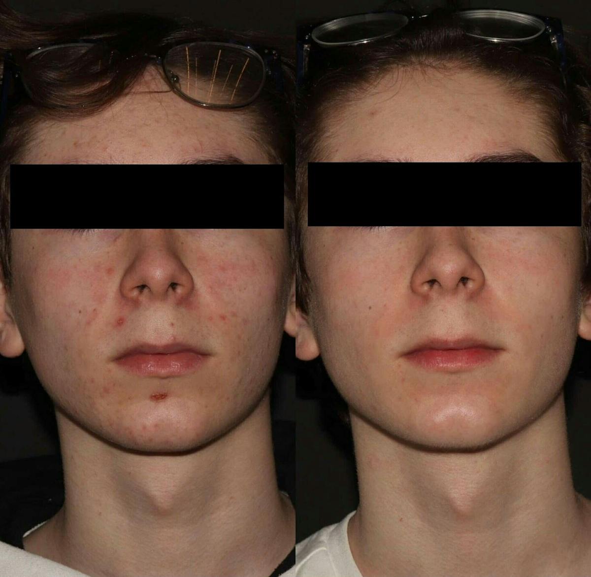 Acne Treatments Before & After Gallery - Patient 282488 - Image 1