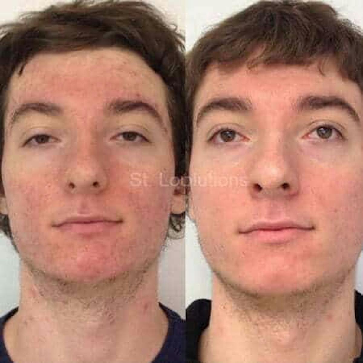 Acne Treatments Before & After Gallery - Patient 121032 - Image 1