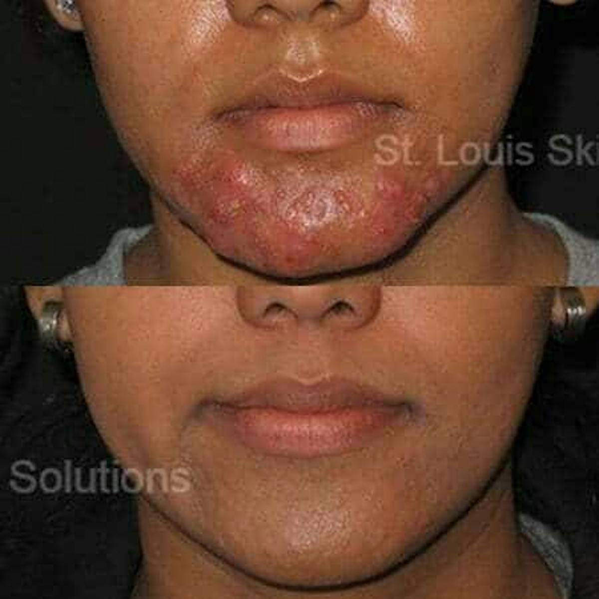 Acne Treatments Before & After Gallery - Patient 295316 - Image 1