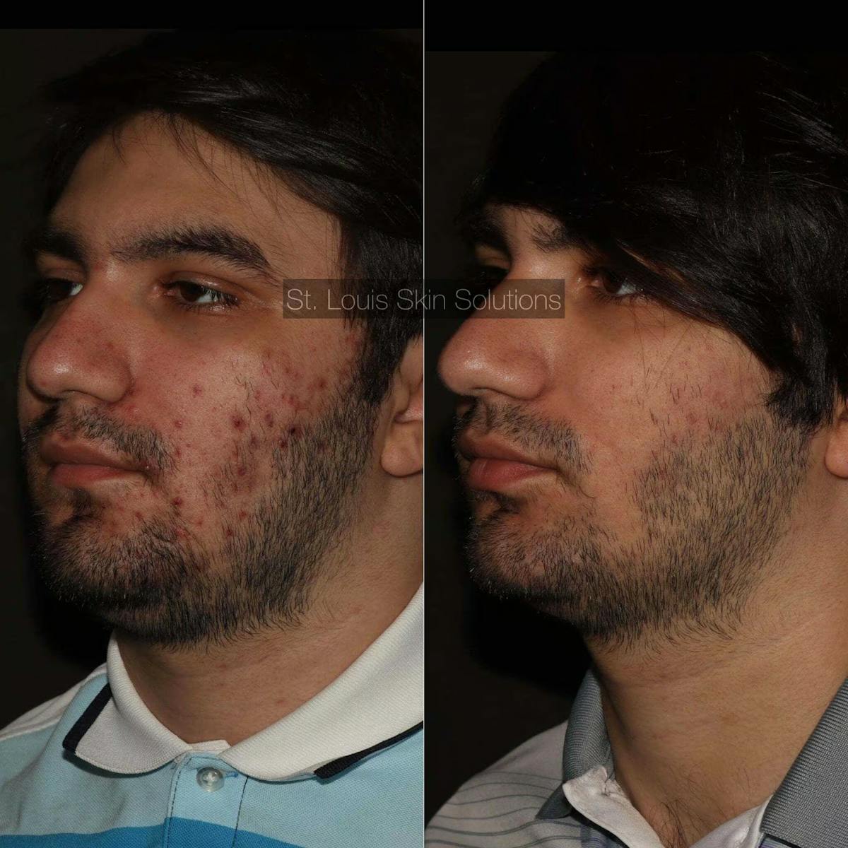 Acne Treatments Before & After Gallery - Patient 219170 - Image 1