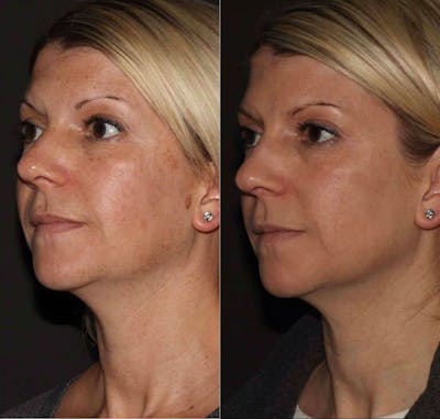 Laser Treatments Before & After Gallery - Patient 379898 - Image 1