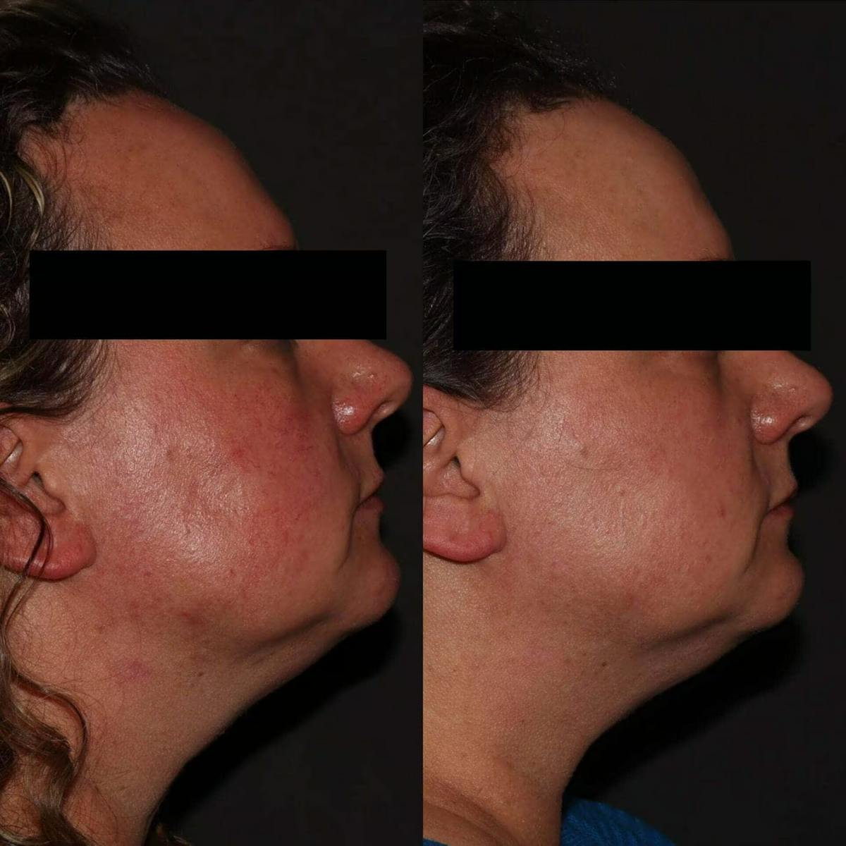 Laser Treatments Before & After Gallery - Patient 751567 - Image 1