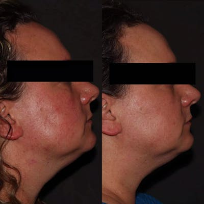 Laser Treatments Before & After Gallery - Patient 751567 - Image 1