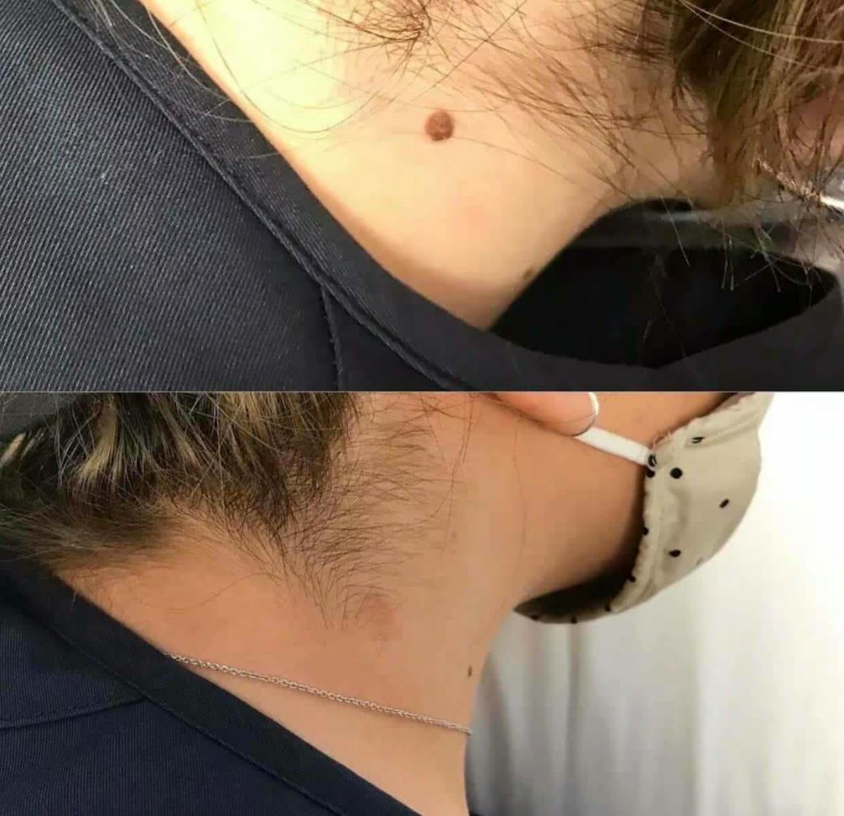 Laser Treatments Before & After Gallery - Patient 213672 - Image 1