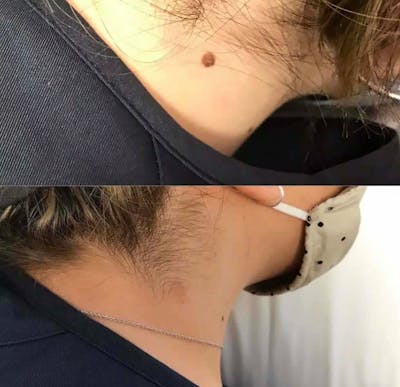 Laser Treatments Before & After Gallery - Patient 213672 - Image 1