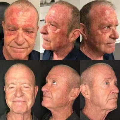 Laser Treatments Before & After Gallery - Patient 340482 - Image 1